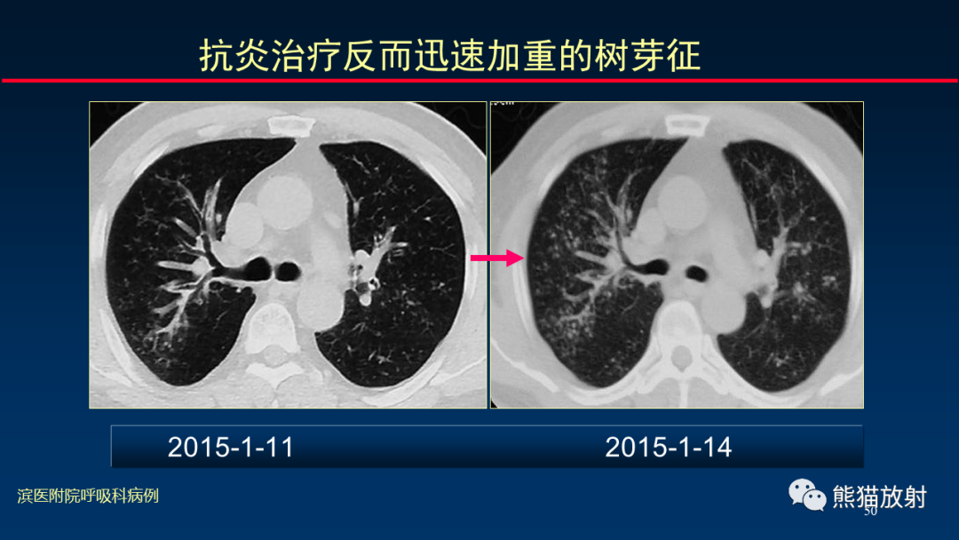 影像PPT - 【PPT】肺真菌感染的CT征象再分析-50