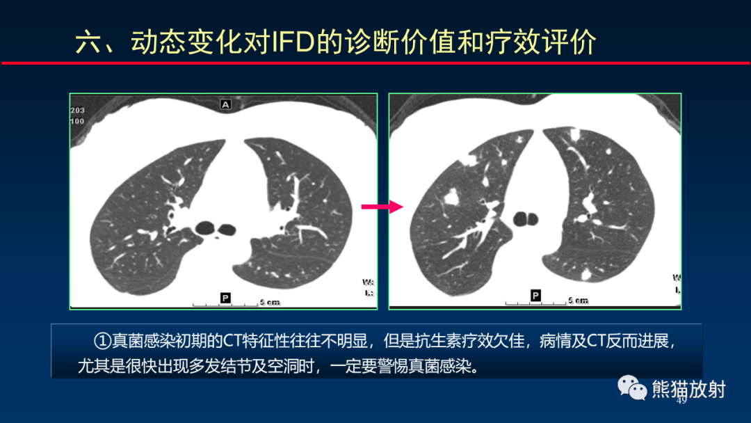 影像PPT - 【PPT】肺真菌感染的CT征象再分析-49