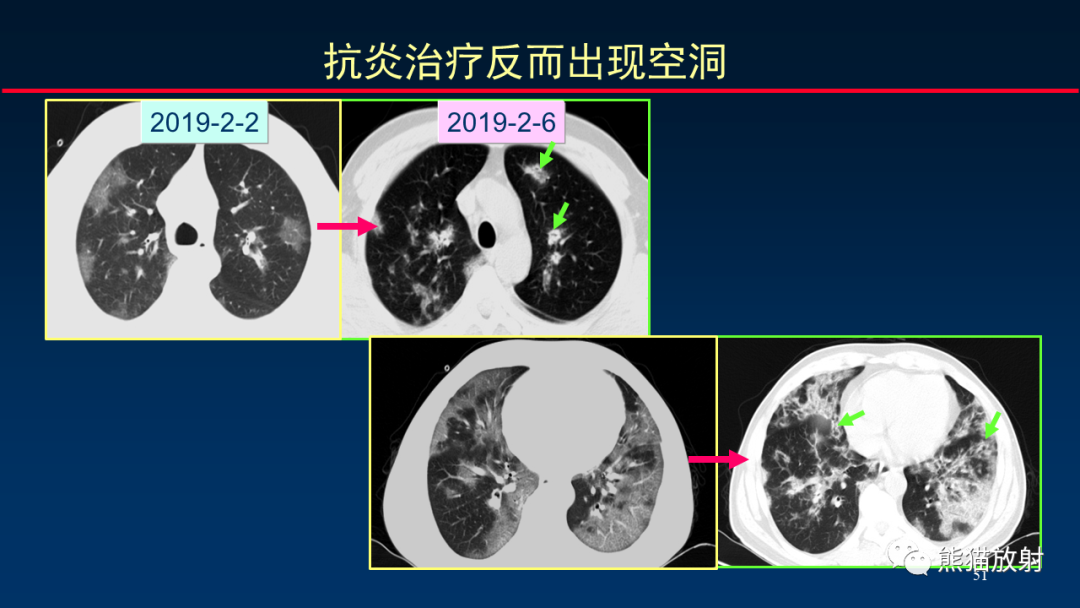 影像PPT - 【PPT】肺真菌感染的CT征象再分析-51