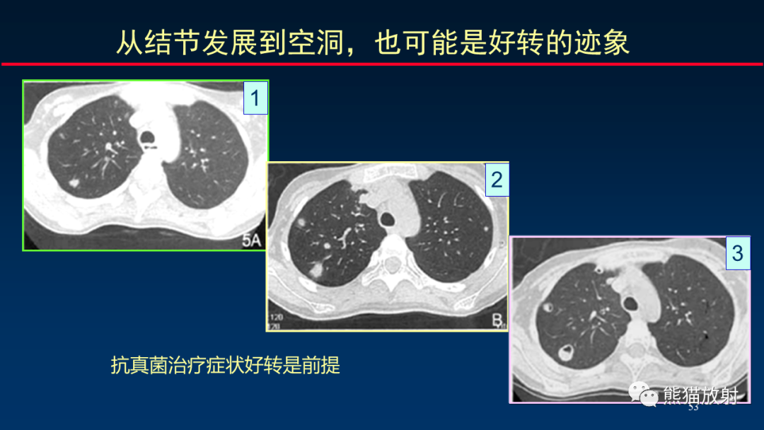 影像PPT - 【PPT】肺真菌感染的CT征象再分析-53