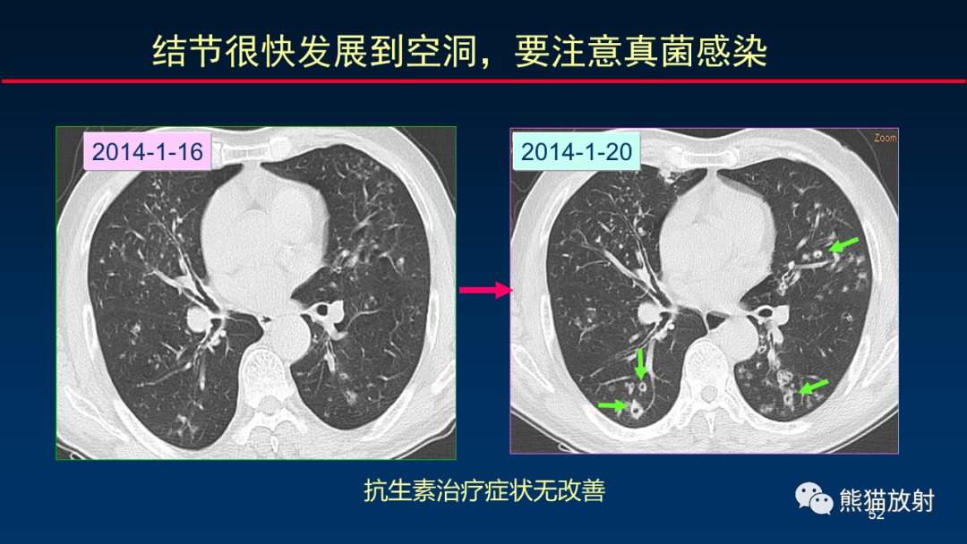 影像PPT - 【PPT】肺真菌感染的CT征象再分析-52
