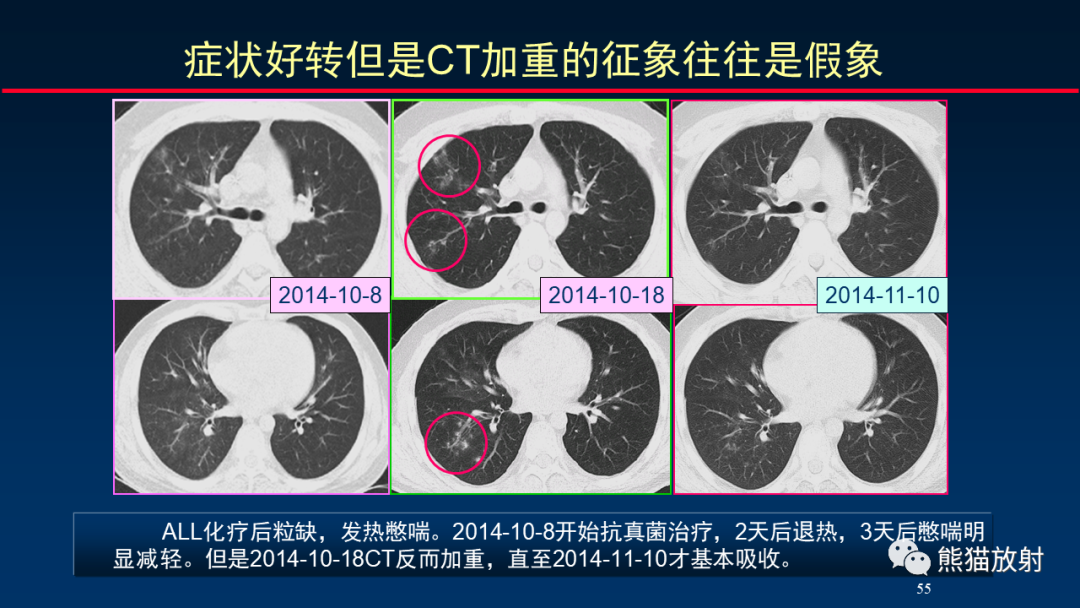 影像PPT - 【PPT】肺真菌感染的CT征象再分析-55
