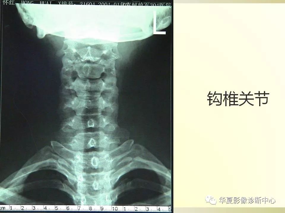 影像PPT - 【PPT】颈椎病影像诊断及临床分型-5