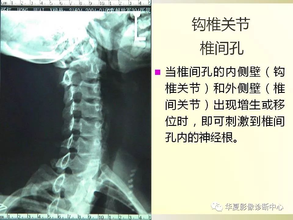影像PPT - 【PPT】颈椎病影像诊断及临床分型-6