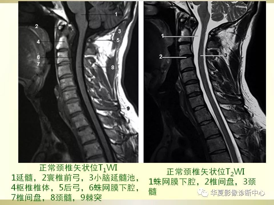 影像PPT - 【PPT】颈椎病影像诊断及临床分型-16