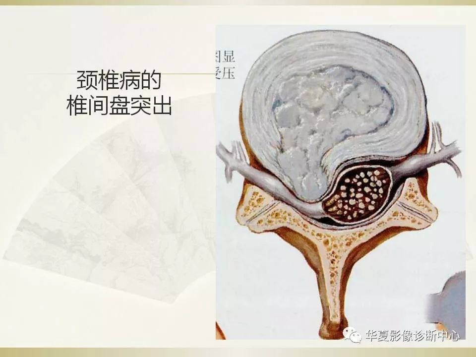 影像PPT - 【PPT】颈椎病影像诊断及临床分型-19