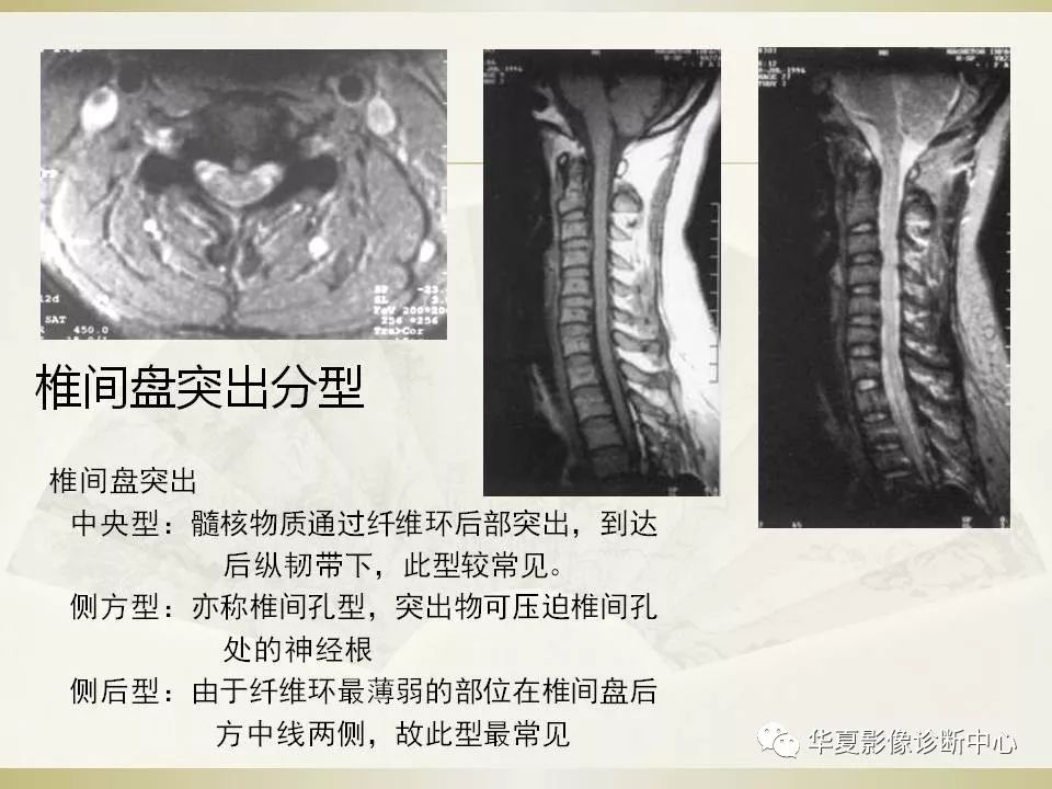 影像PPT - 【PPT】颈椎病影像诊断及临床分型-20