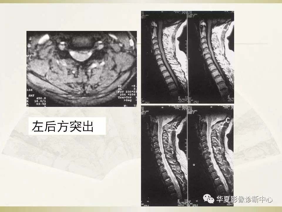 影像PPT - 【PPT】颈椎病影像诊断及临床分型-21