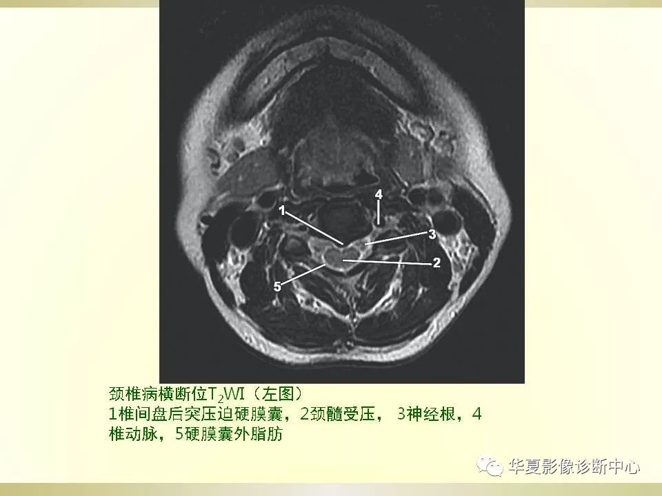 影像PPT - 【PPT】颈椎病影像诊断及临床分型-26