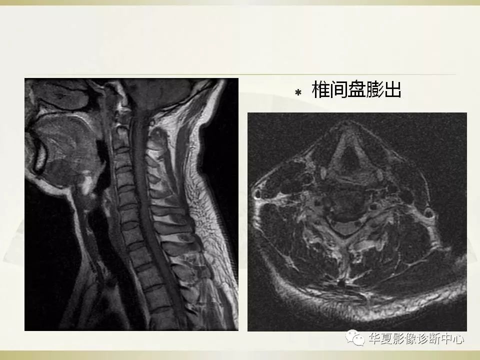 影像PPT - 【PPT】颈椎病影像诊断及临床分型-27