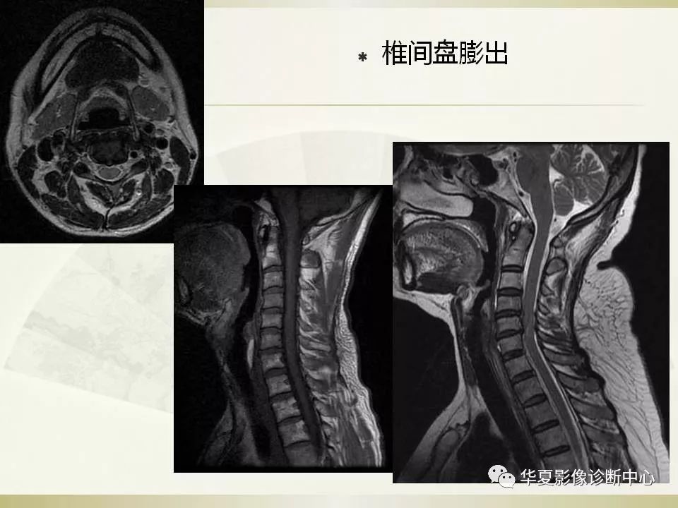 影像PPT - 【PPT】颈椎病影像诊断及临床分型-28