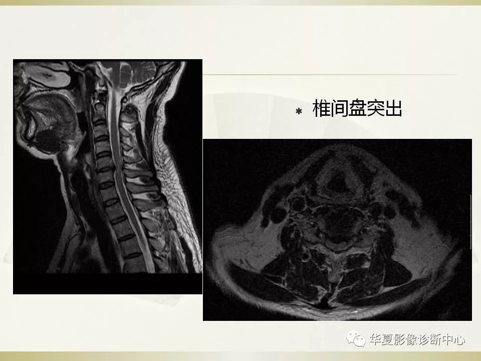 影像PPT - 【PPT】颈椎病影像诊断及临床分型-29