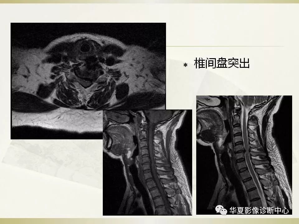 影像PPT - 【PPT】颈椎病影像诊断及临床分型-30