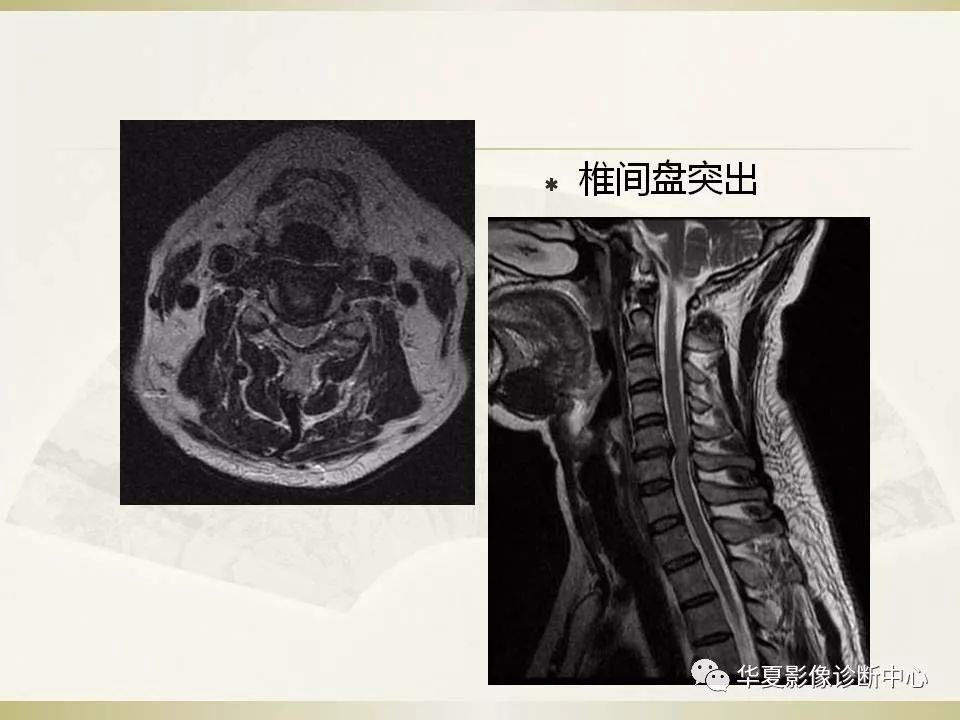影像PPT - 【PPT】颈椎病影像诊断及临床分型-31
