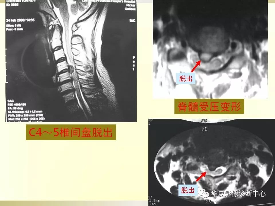 影像PPT - 【PPT】颈椎病影像诊断及临床分型-32