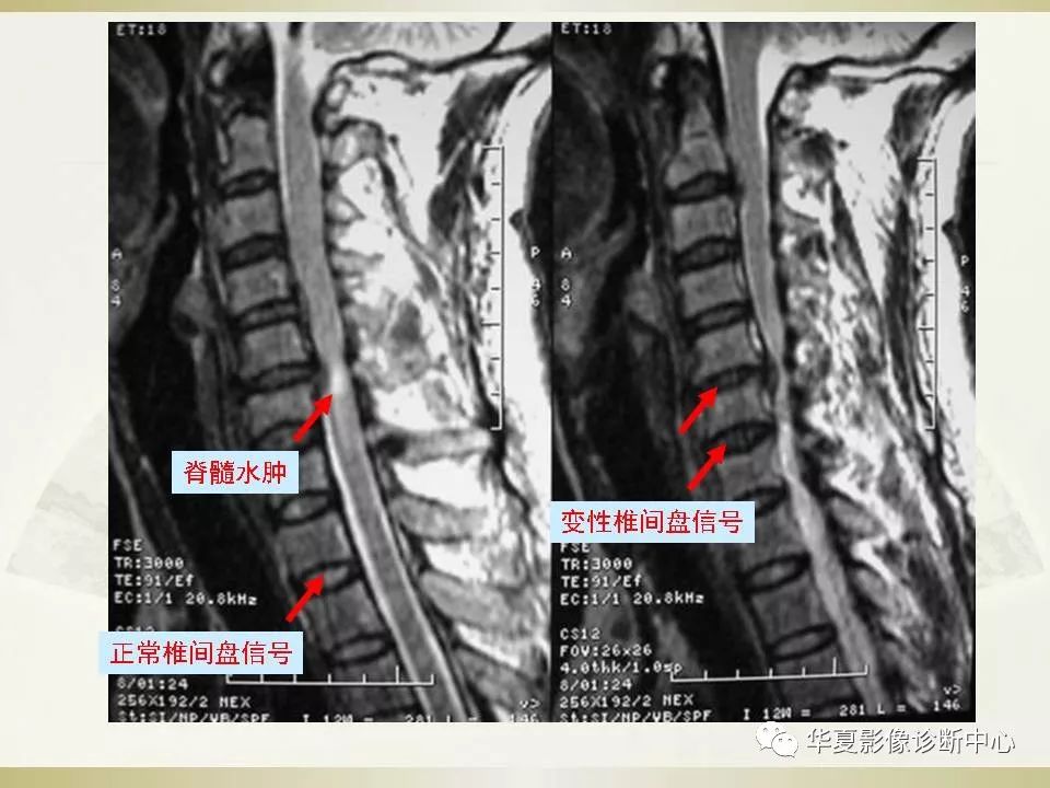 影像PPT - 【PPT】颈椎病影像诊断及临床分型-34