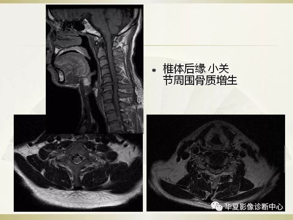 影像PPT - 【PPT】颈椎病影像诊断及临床分型-37