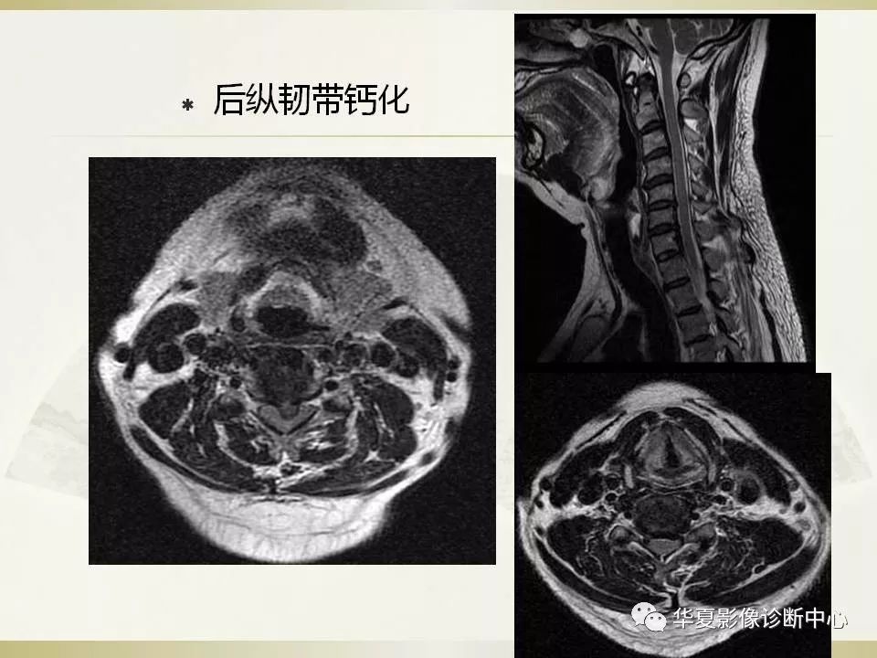 影像PPT - 【PPT】颈椎病影像诊断及临床分型-35