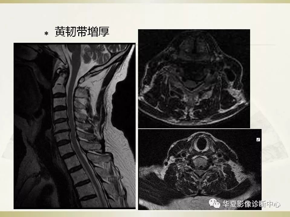 影像PPT - 【PPT】颈椎病影像诊断及临床分型-36