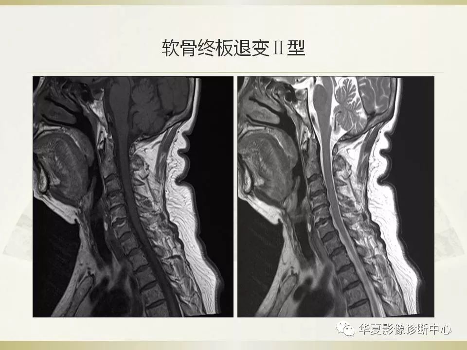 影像PPT - 【PPT】颈椎病影像诊断及临床分型-38