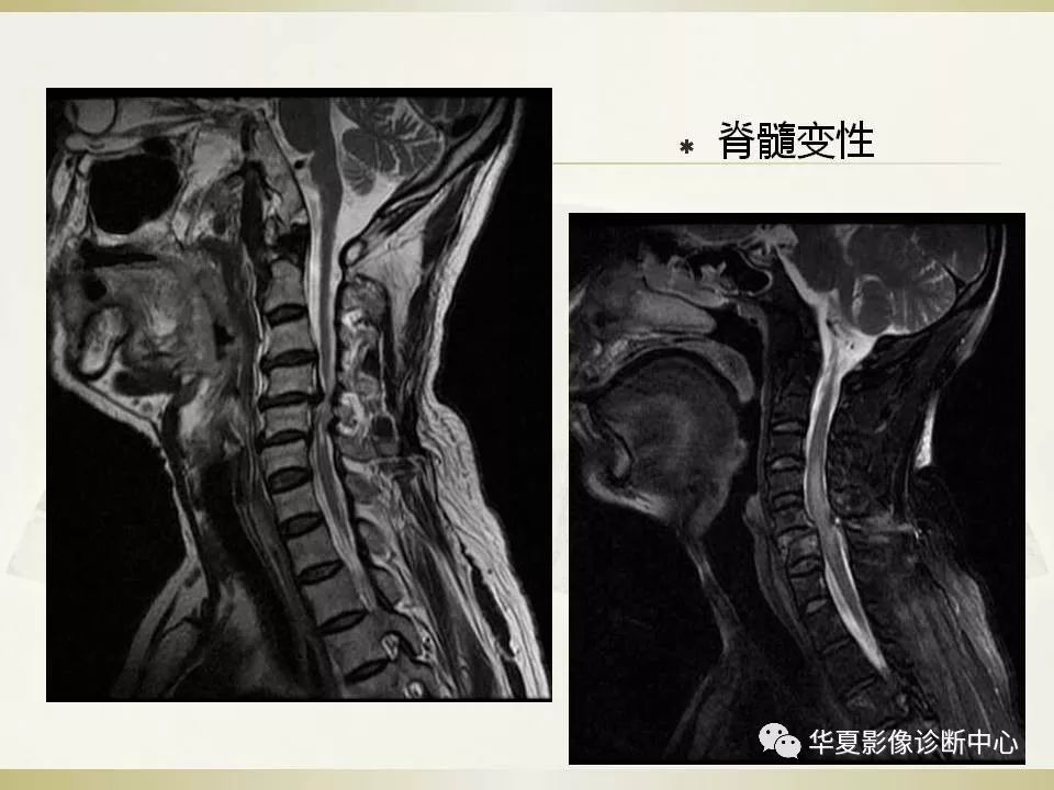 影像PPT - 【PPT】颈椎病影像诊断及临床分型-39