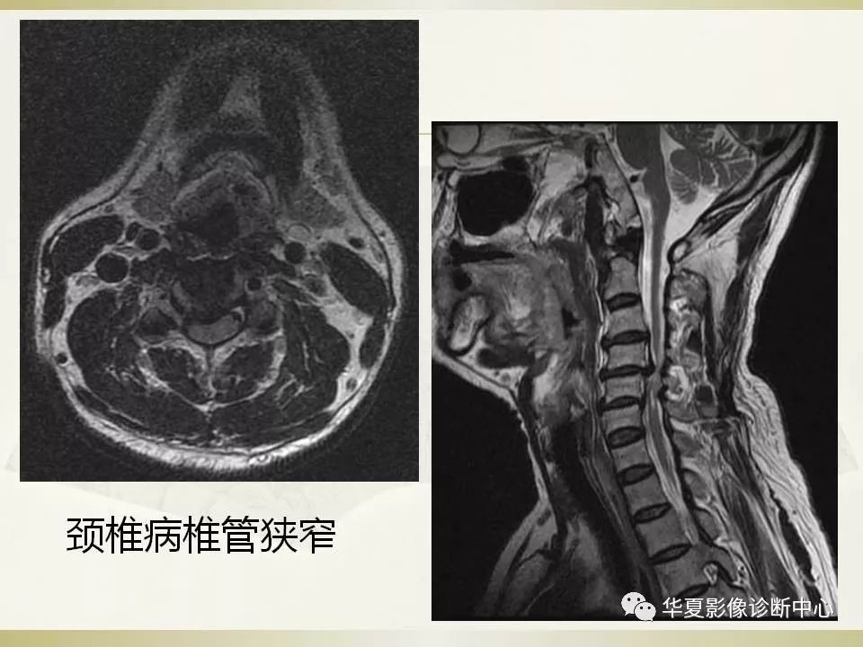 影像PPT - 【PPT】颈椎病影像诊断及临床分型-41
