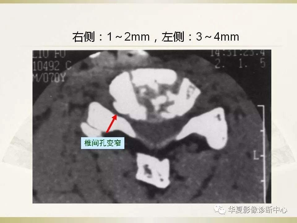 影像PPT - 【PPT】颈椎病影像诊断及临床分型-46
