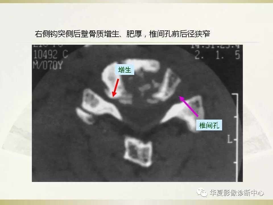 影像PPT - 【PPT】颈椎病影像诊断及临床分型-45