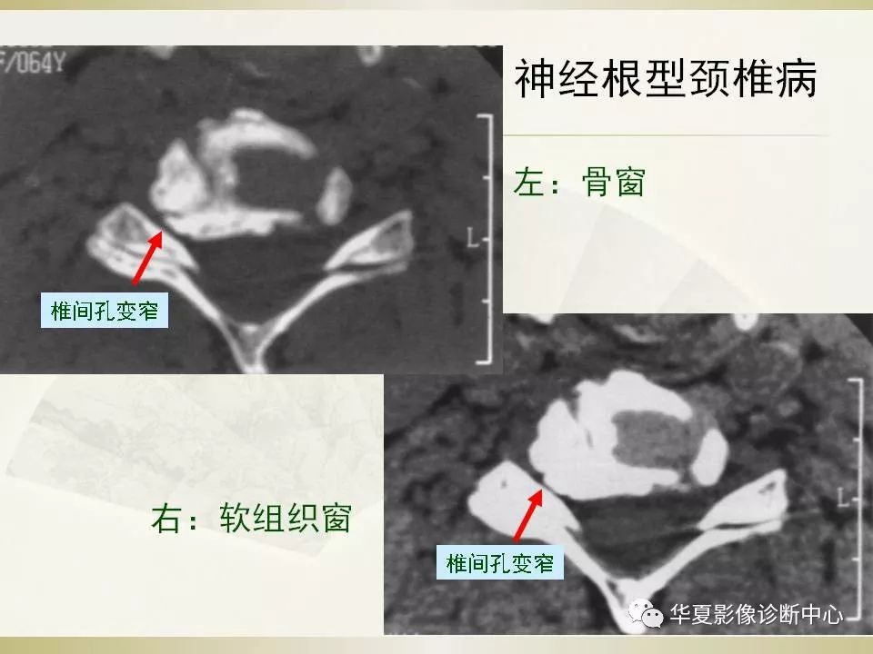 影像PPT - 【PPT】颈椎病影像诊断及临床分型-47