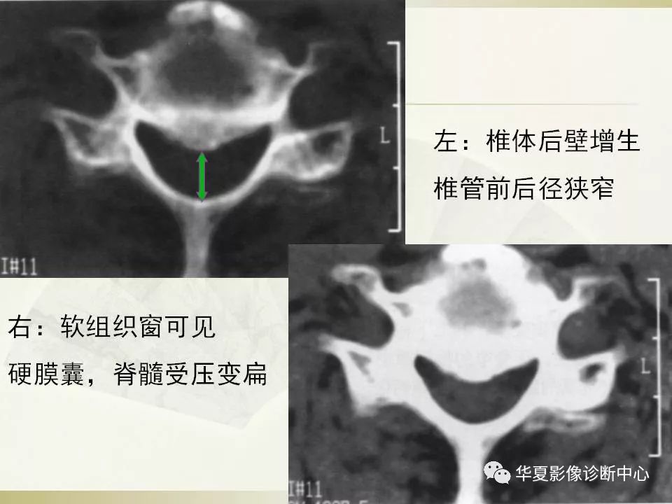 影像PPT - 【PPT】颈椎病影像诊断及临床分型-51
