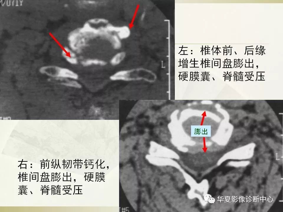 影像PPT - 【PPT】颈椎病影像诊断及临床分型-52