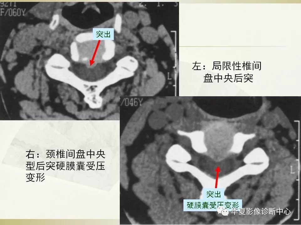 影像PPT - 【PPT】颈椎病影像诊断及临床分型-53