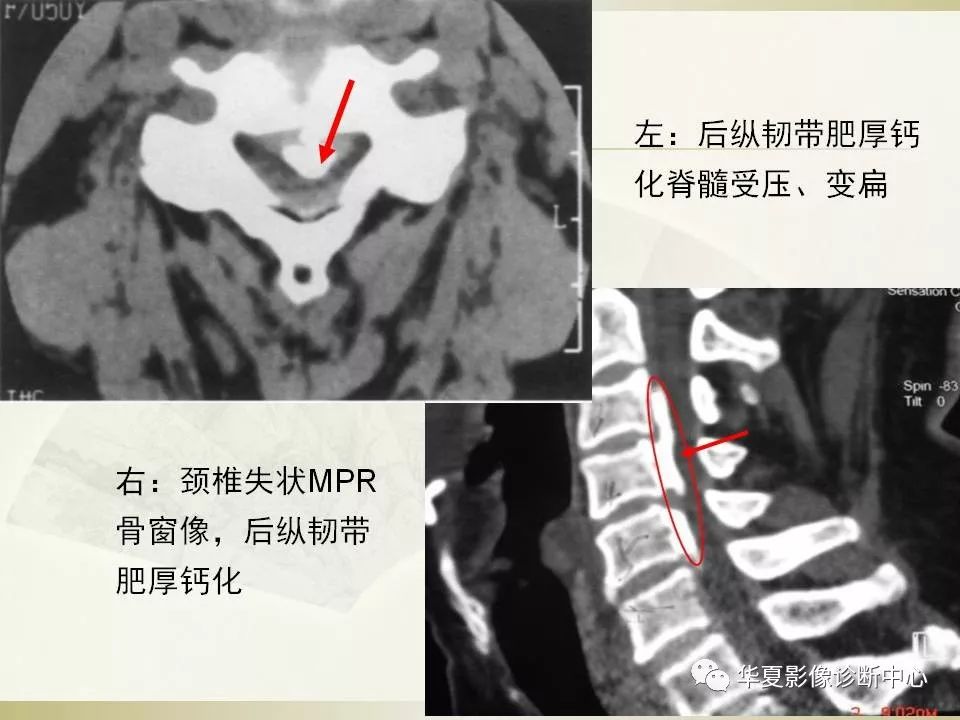 影像PPT - 【PPT】颈椎病影像诊断及临床分型-54