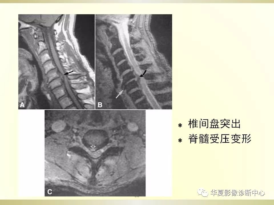 影像PPT - 【PPT】颈椎病影像诊断及临床分型-55