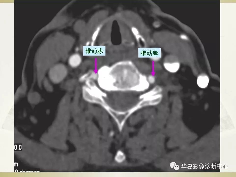 影像PPT - 【PPT】颈椎病影像诊断及临床分型-60