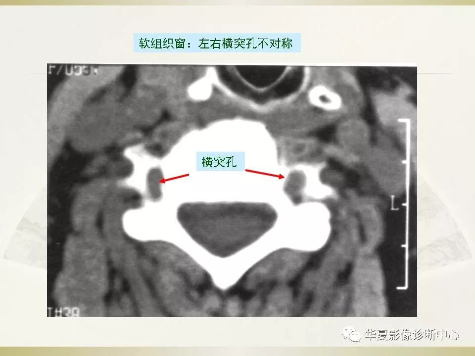 影像PPT - 【PPT】颈椎病影像诊断及临床分型-61