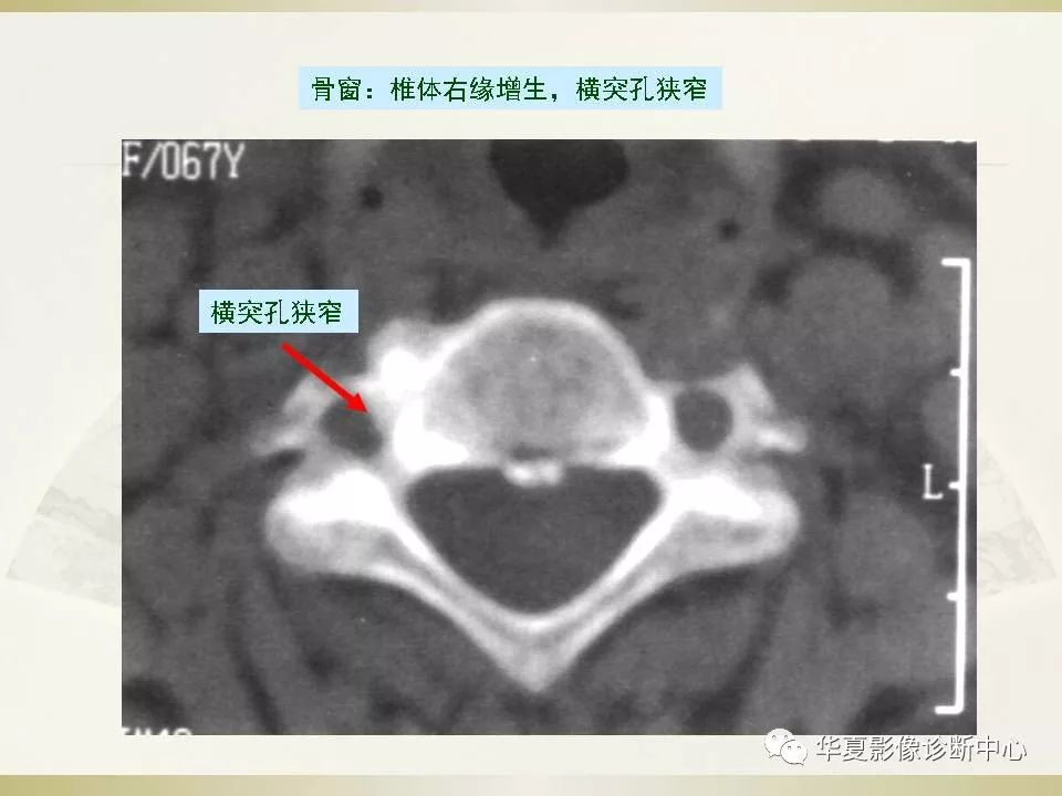 影像PPT - 【PPT】颈椎病影像诊断及临床分型-59