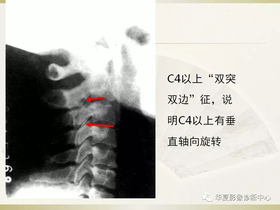 影像PPT - 【PPT】颈椎病影像诊断及临床分型-65