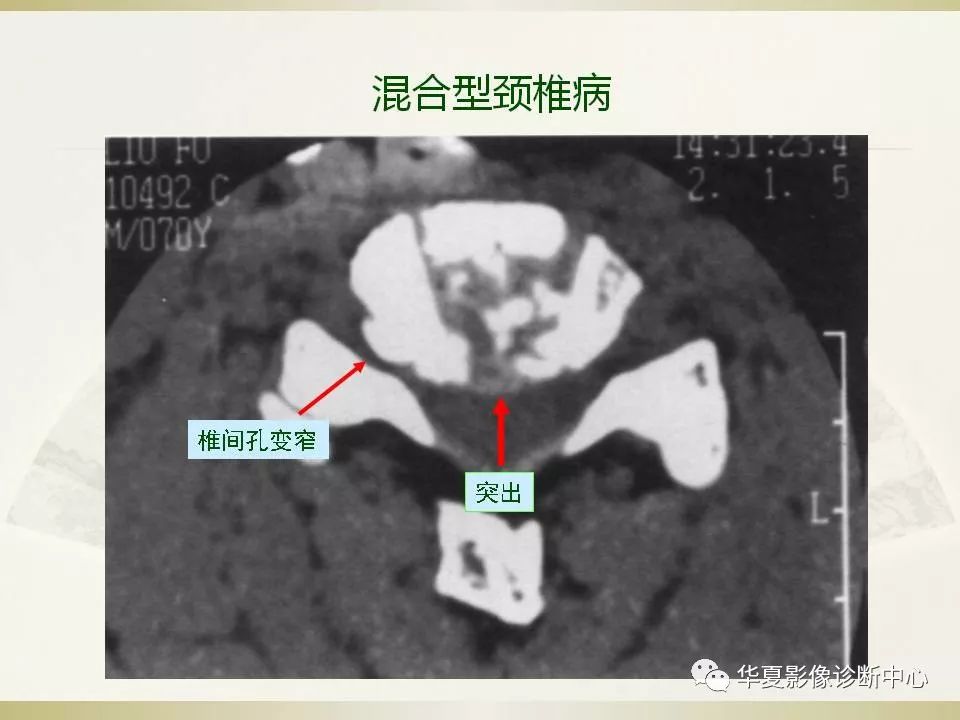 影像PPT - 【PPT】颈椎病影像诊断及临床分型-70