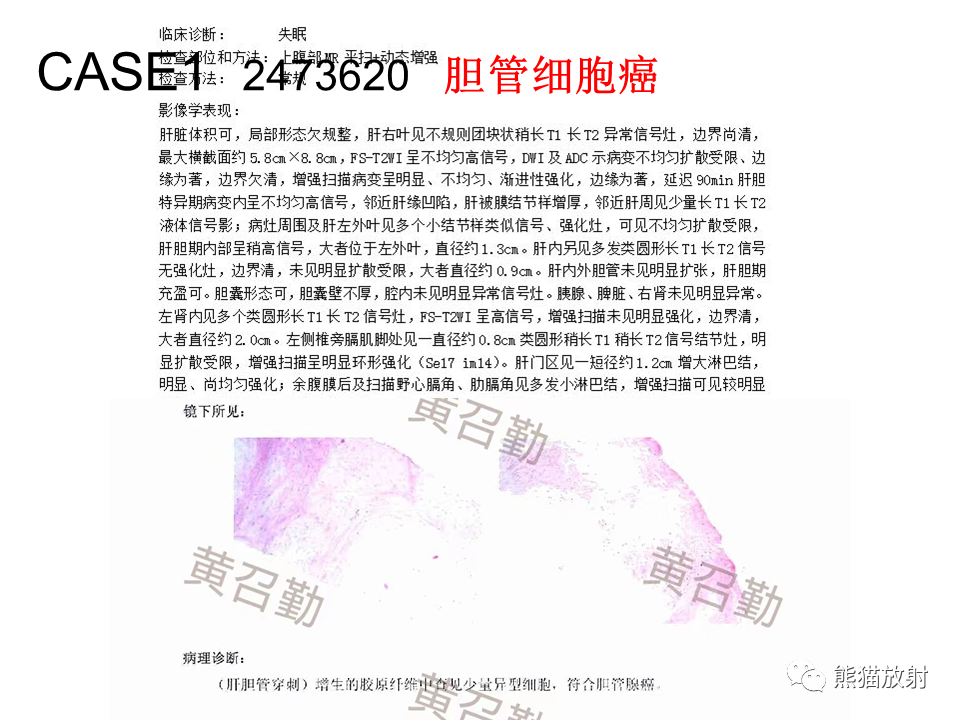 影像PPT - 【病例】肝内胆管细胞癌2例MR影像-15