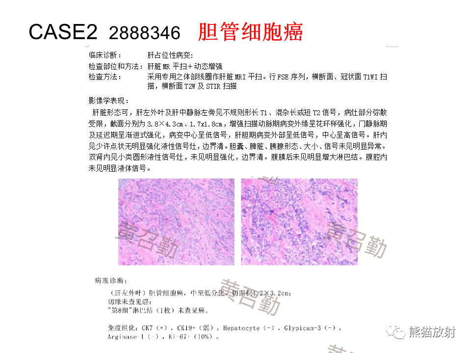 影像PPT - 【病例】肝内胆管细胞癌2例MR影像-16
