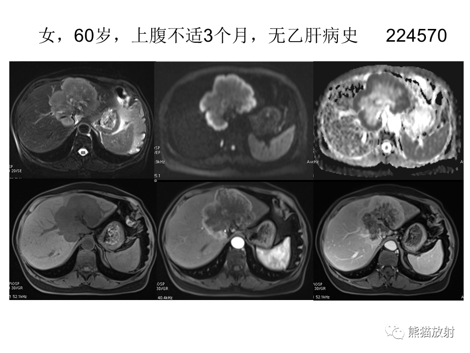 影像PPT - 【病例】肝内胆管细胞癌2例MR影像-23