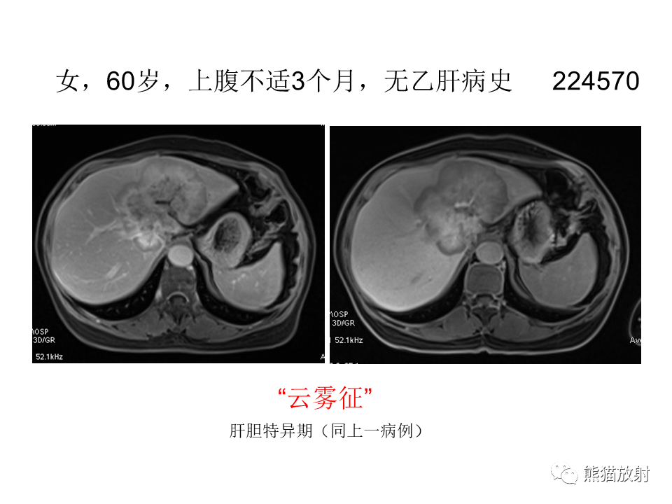 影像PPT - 【病例】肝内胆管细胞癌2例MR影像-24