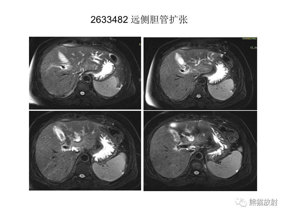影像PPT - 【病例】肝内胆管细胞癌2例MR影像-26