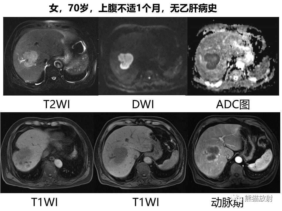 影像PPT - 【病例】肝内胆管细胞癌2例MR影像-30