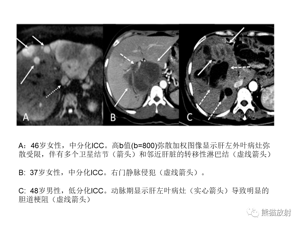 影像PPT - 【病例】肝内胆管细胞癌2例MR影像-32
