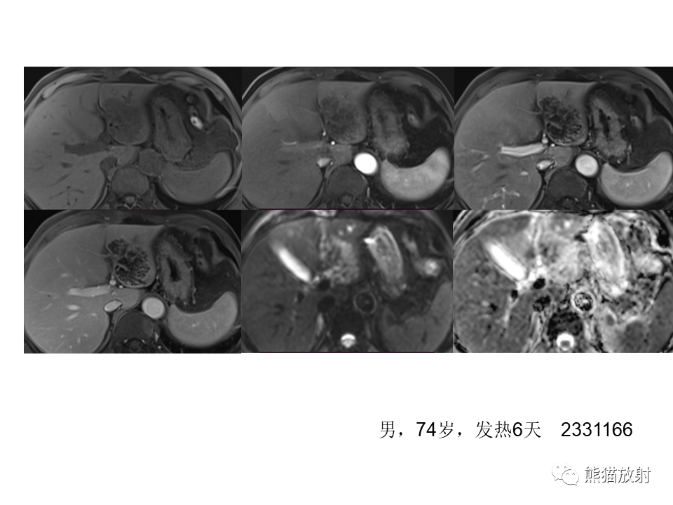 影像PPT - 【病例】肝内胆管细胞癌2例MR影像-39