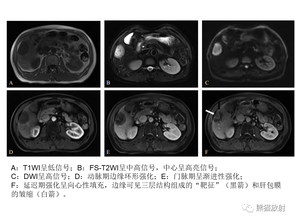影像PPT - 【病例】肝内胆管细胞癌2例MR影像-41