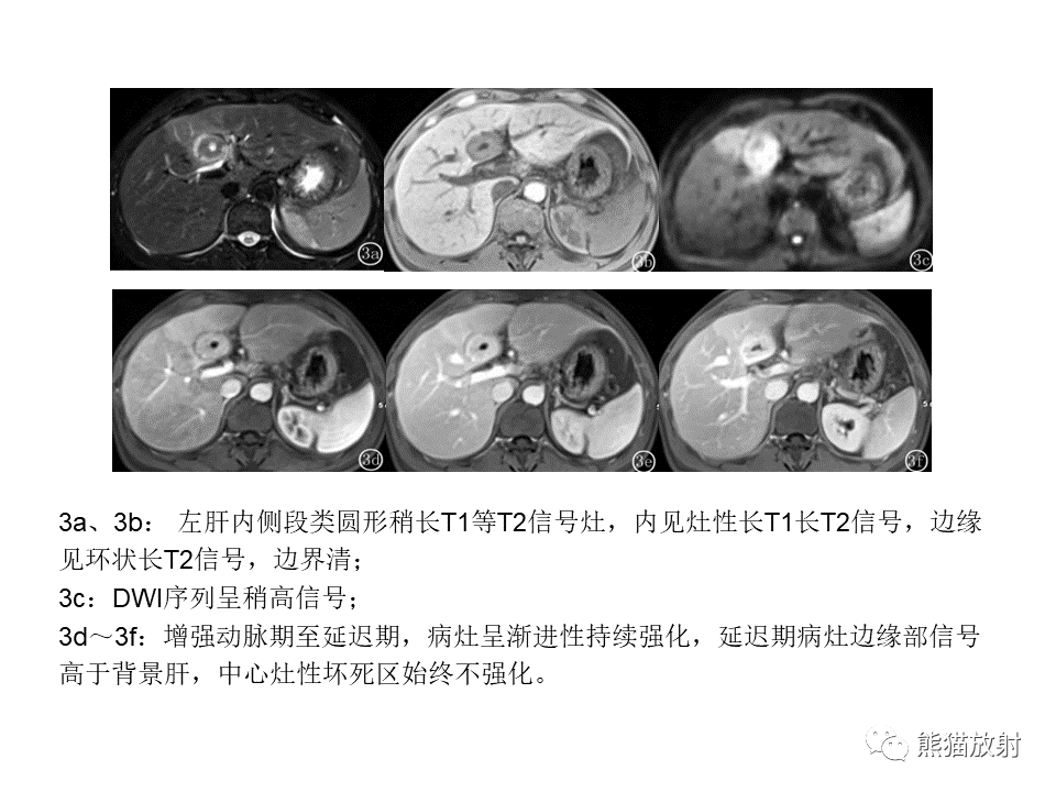 影像PPT - 【病例】肝内胆管细胞癌2例MR影像-44