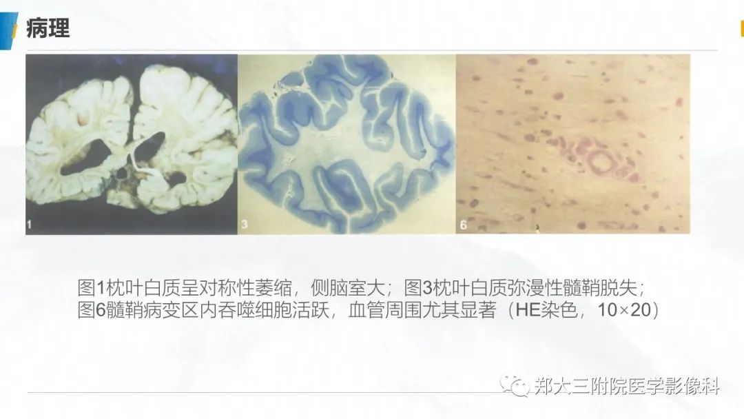 影像PPT - 【PPT】肾上腺脑白质营养不良影像诊断-5